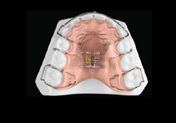 myobrace appliance