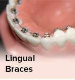 lingual_braces