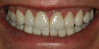 porcelain_veneers