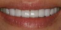 whitening