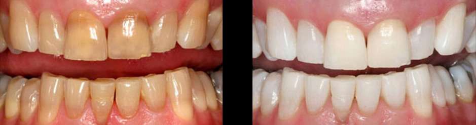 teeth whitening before and after