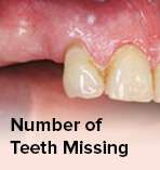 teeth missing