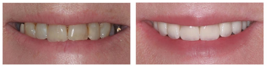 Porcelain Veneers Sydney