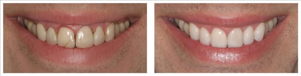 Porcelain Veneers Sydney