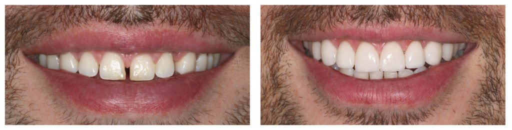 Porcelain Veneers Sydney