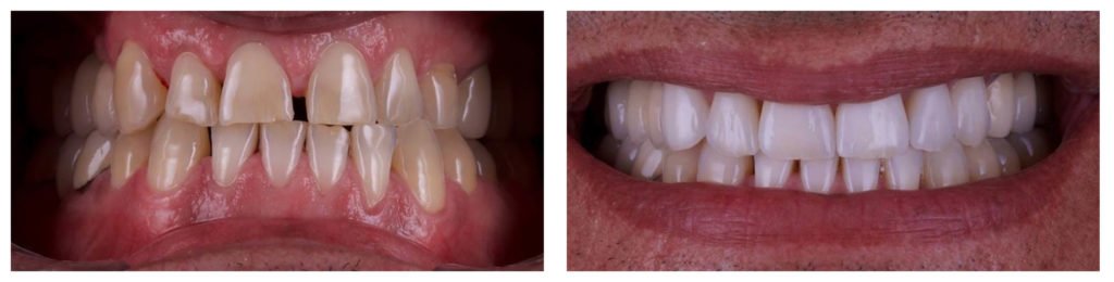 Porcelain Veneers Sydney