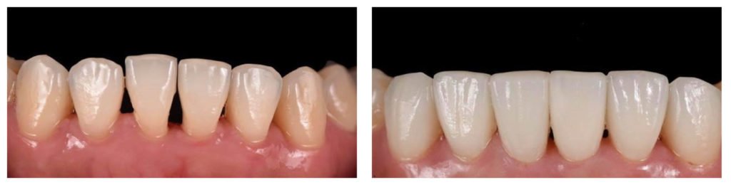 Porcelain Veneers Sydney