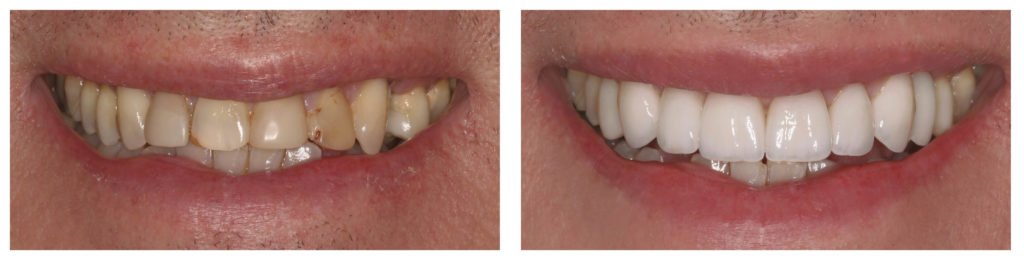 Porcelain Veneers Sydney