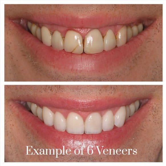 natural looking porcelain veneers