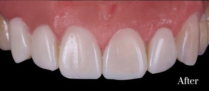 composite veneers