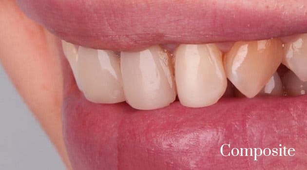 composite to porcelain veneers