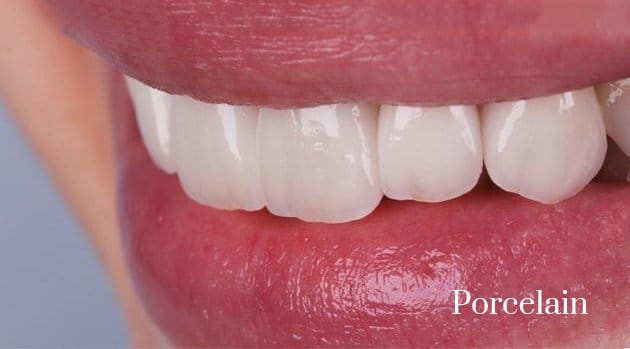 composite to porcelain veneers