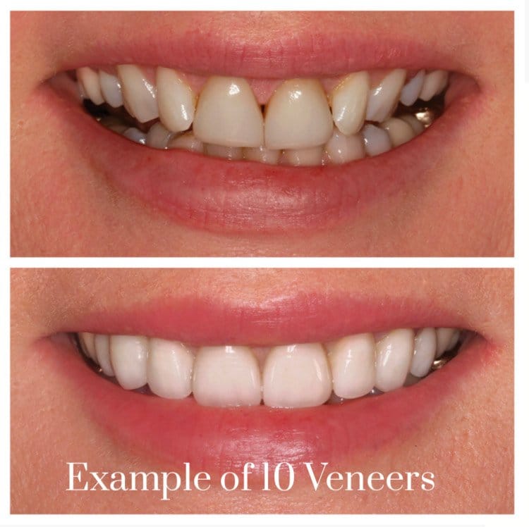 porcelain veneers