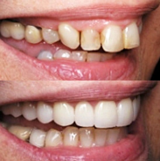 Cosmetic Dentistry gum recontouring