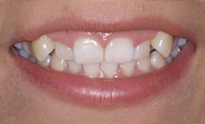 Cosmetic Dentistry gum recontouring