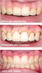 Cosmetic Dentistry gum recontouring