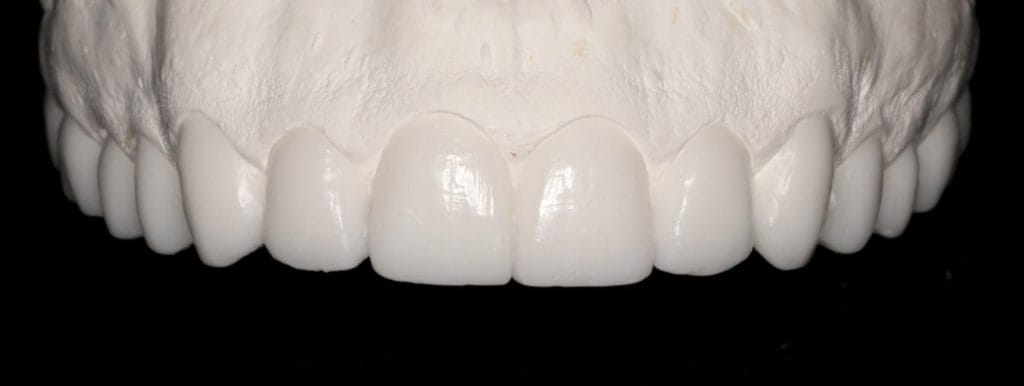 porcelain veneers model