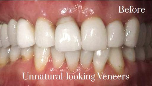 natural looking porcelain veneers