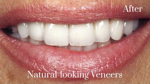 porcelain veneers before and after