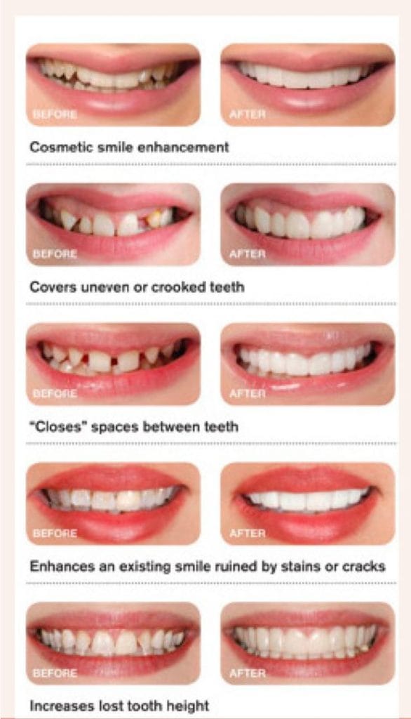 snap on smile before and after