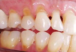 abrasion causes worn teeth