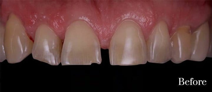 composite veneers