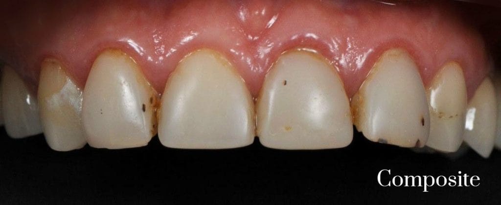 composite to porcelain veneers