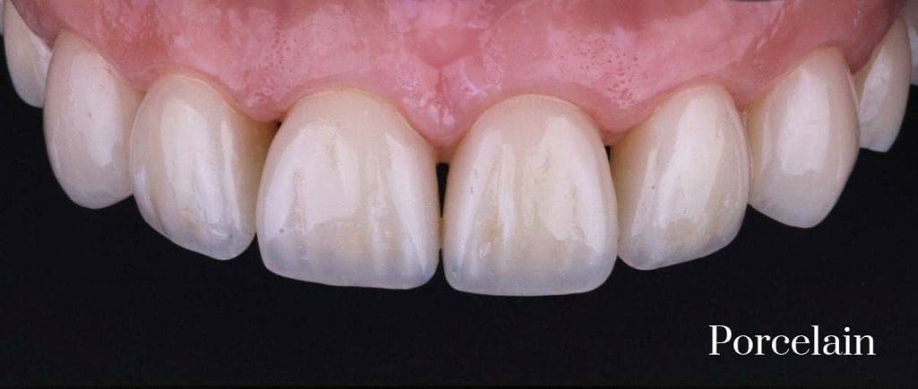 composite to porcelain veneers