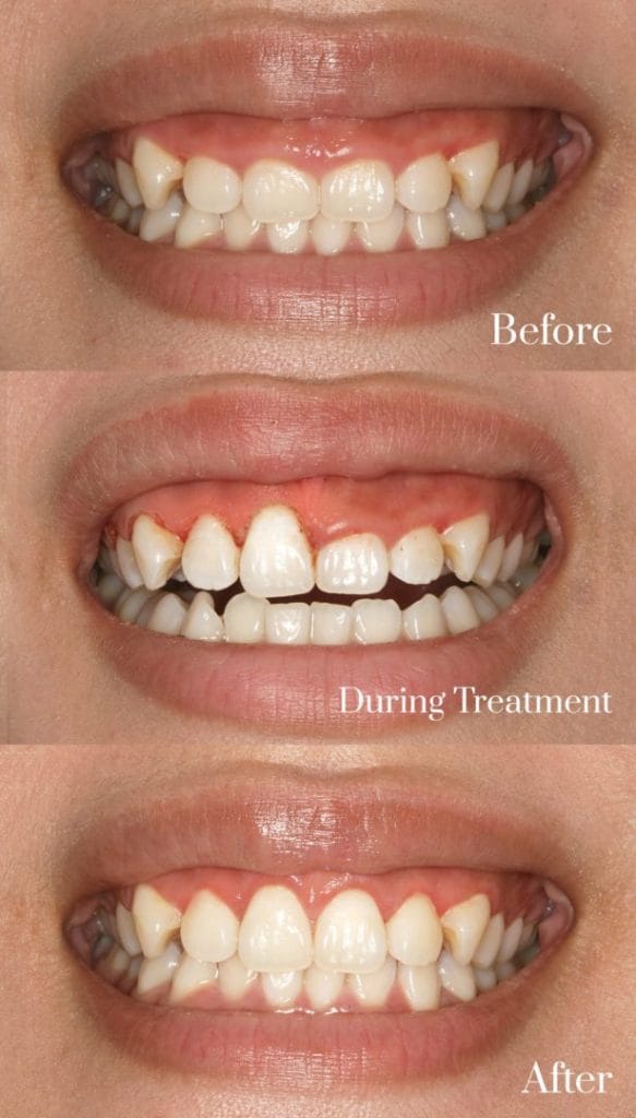 gum contouring treatment