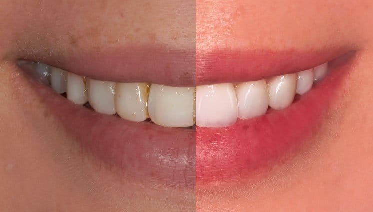 homepage before and after porcelain veneers