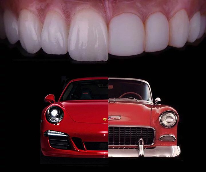 what is a quality porcelain veneers