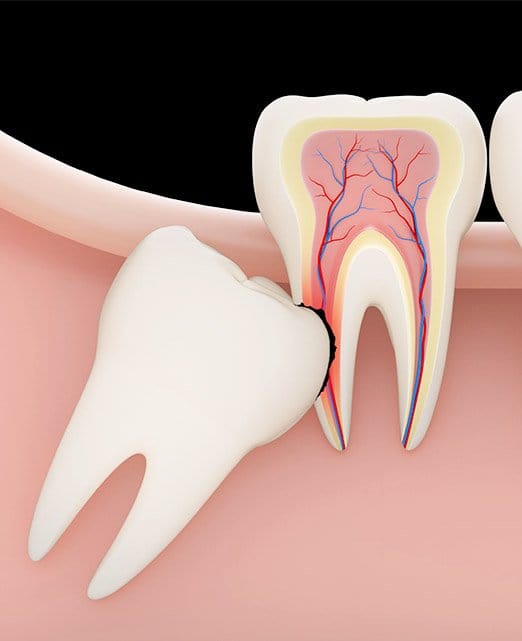 wisdom teeth diagram