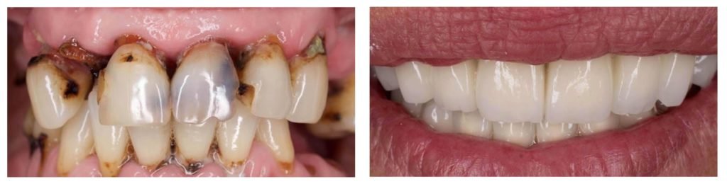 Porcelain Veneers Sydney