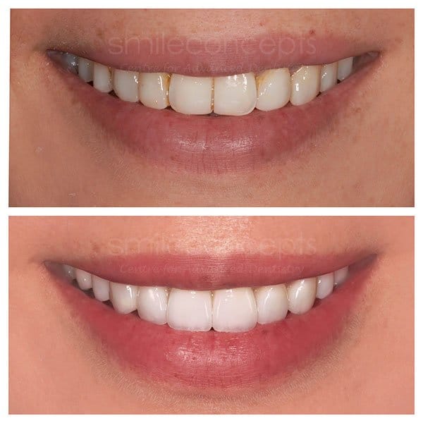 porcelain veneers 25