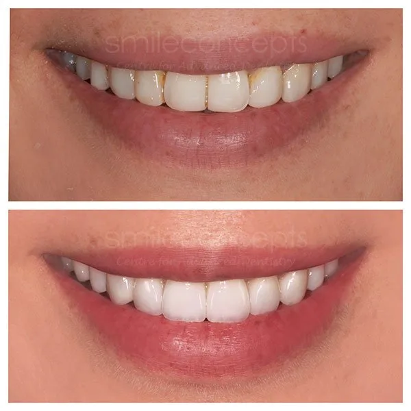 porcelain veneers 25