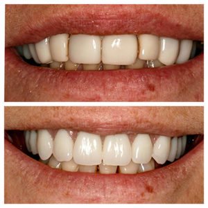 all teeth missing before and after 2