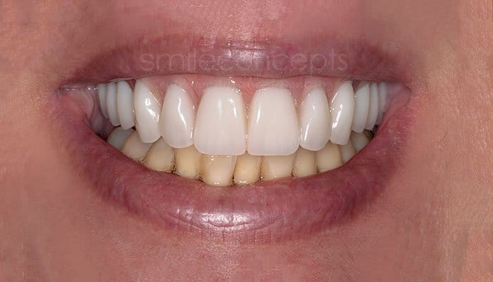 all on four before and after 1