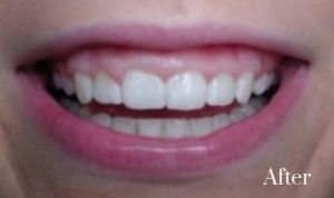 gummy smile treatment 3