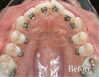 lingual braces 9
