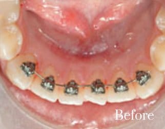 lingual braces 7