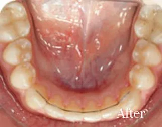 lingual braces 6