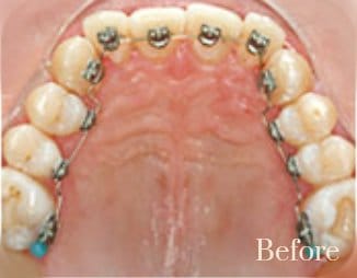 lingual braces 5