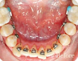 lingual braces 3