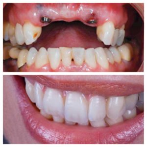 multiple teeth missing before and after 9