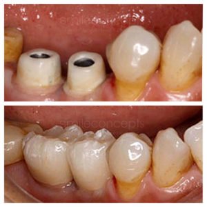 multiple teeth missing before and after 5