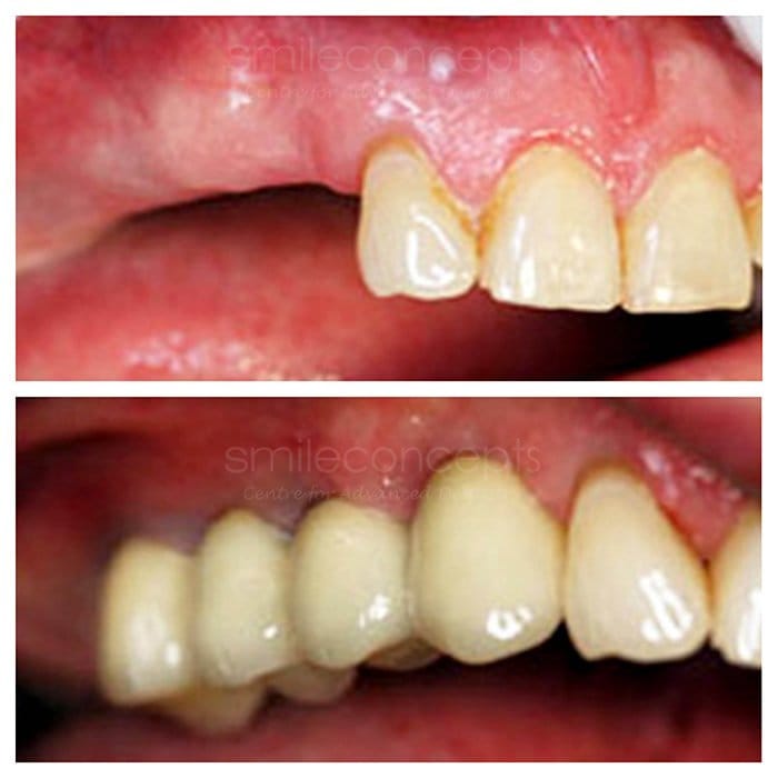 multiple teeth missing before and after 2