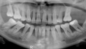 multiple teeth missing before and after 29