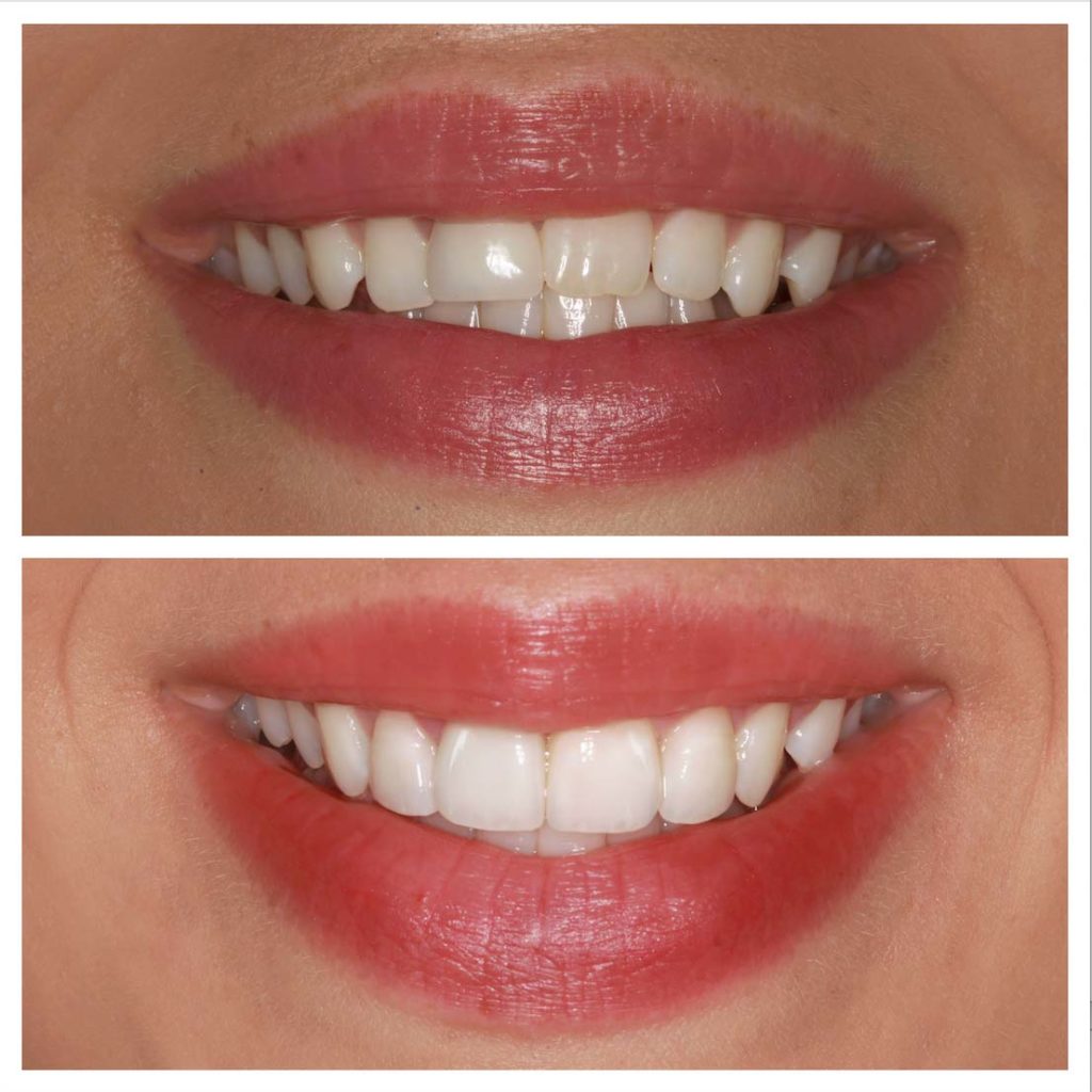 misaligned teeth before and after