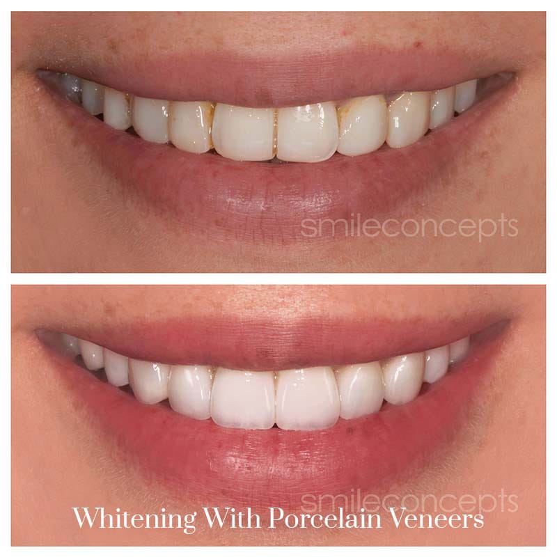 porcelain veneers for whitening