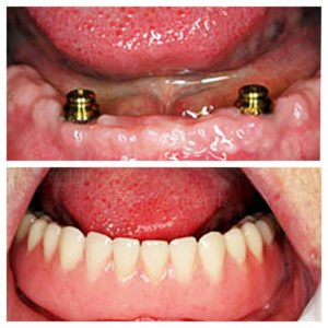 all teeth missing before and after 1